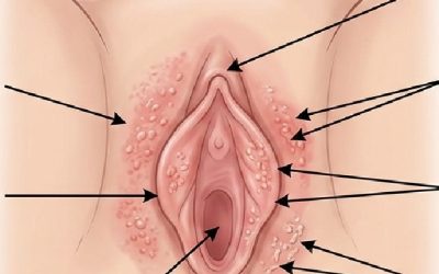 Irritation vulvaire