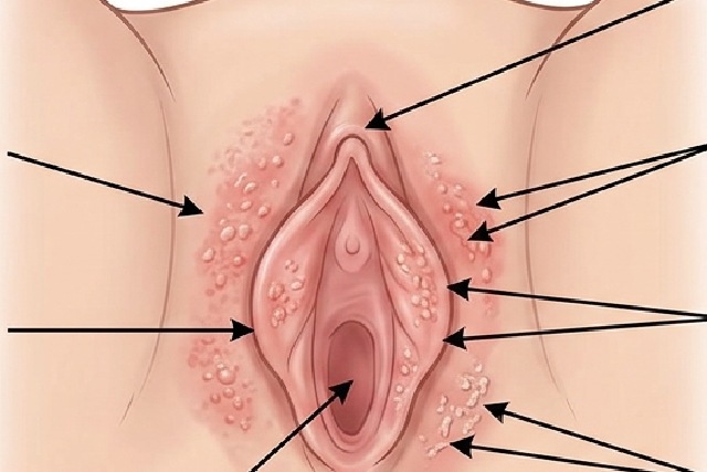 Irritation vulvaire